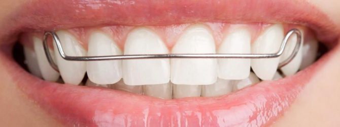 Placas de alinhamento dos dentes