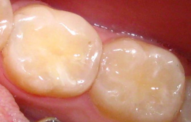 Riempimento di plastica sul dente