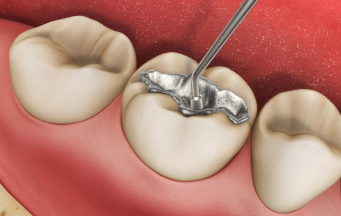 Plnění zubů