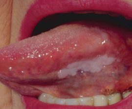 Leucoplasie à langue plate