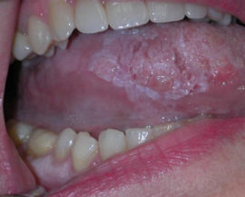 Liežuvio liežuvio karcinoma