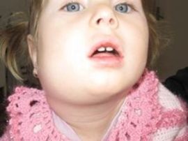 Submandibuläre Lymphadenitis bei einem Kind