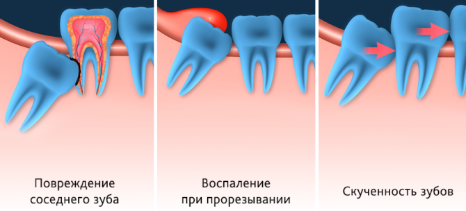 Indications for removing a wisdom tooth