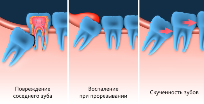 Hậu quả của việc mọc răng khôn không đúng cách