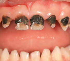 مرحلة متأخرة من تسوس الأسنان اللبنية