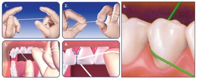 Règles d'utilisation de la soie dentaire