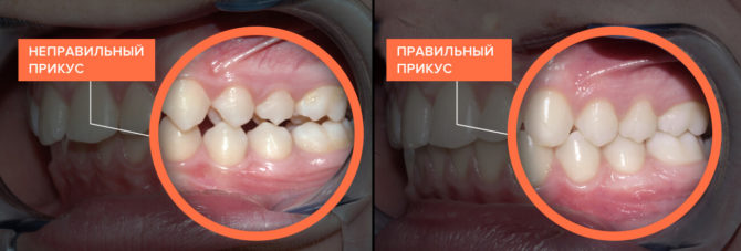 Droite et mauvaise morsure de dents