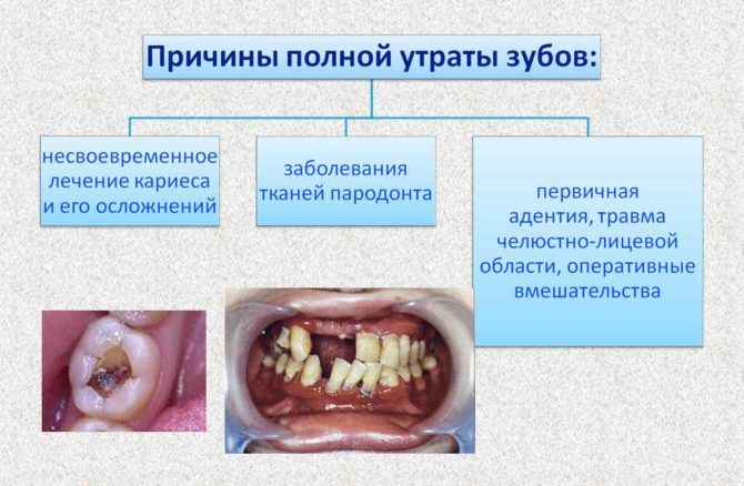 Cause di perdita completa dei denti