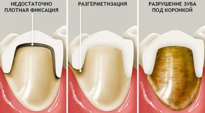 Příčiny bolesti zubů pod korunou