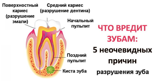 Causes of tooth loss