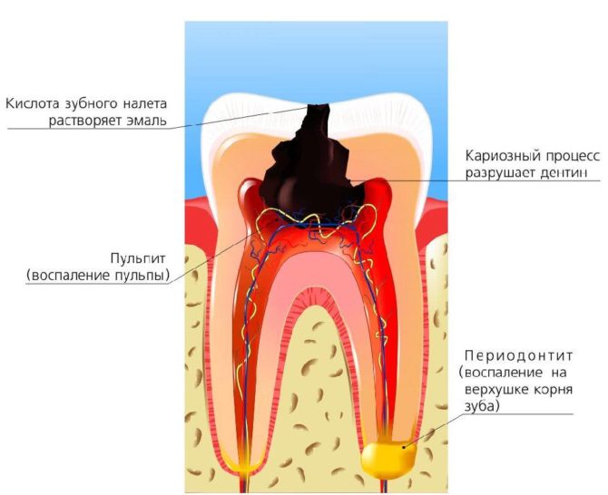 Príčiny bolesti zubov