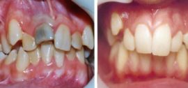 Examples of vestibular and medial dystopia of the tooth