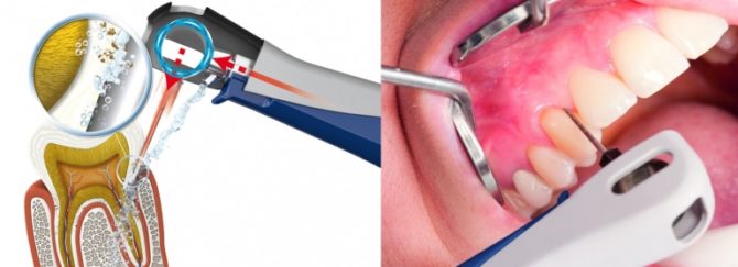 O princípio do processamento de bolsos periodontais com o dispositivo Vector