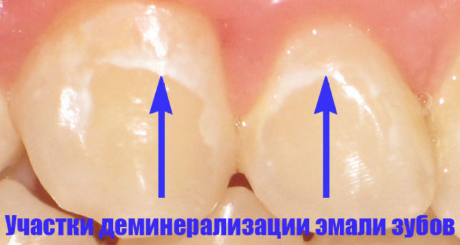 Znak demineralizacji szkliwa zębów