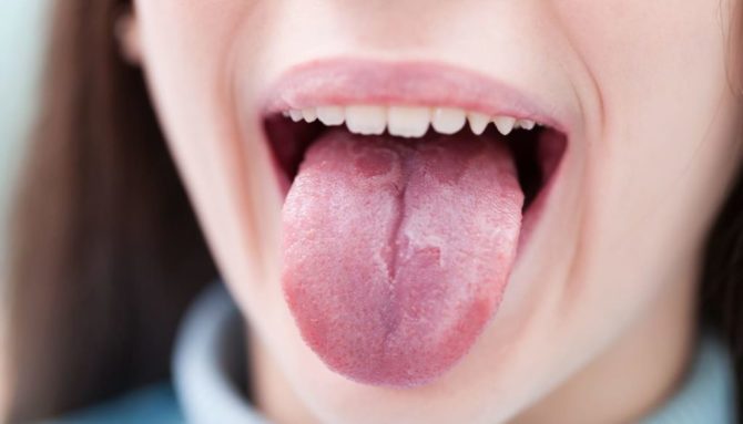 Tegn på en sykdom i tungen