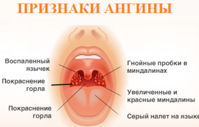 Signs of a sore throat