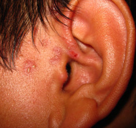 Zeichen von Fieberbläschen im Ohr