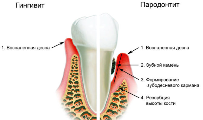 Signs of gingivitis and periodontitis