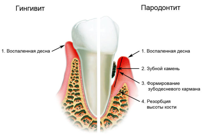 Mga palatandaan ng gingivitis at periodontitis