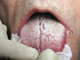 Signs of candidiasis