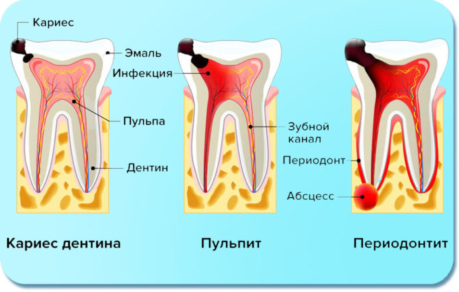 Signs of caries, pulpitis and periodontitis