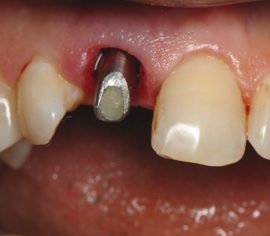 Signos de rechazo de implantes dentales.