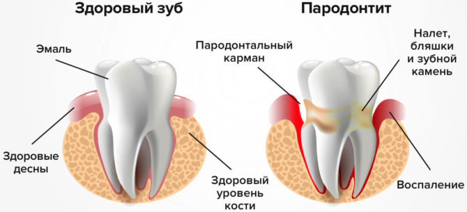 Tegn på periodontitt
