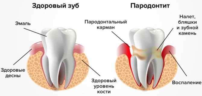 Signs of Periodontitis