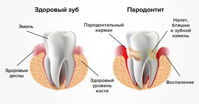 Tecken på periodontit