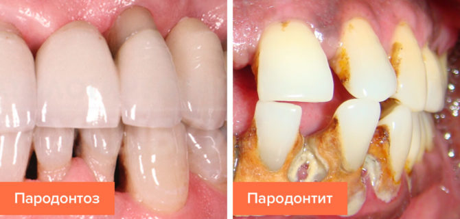 Tegn på parodontal sykdom og periodontitt