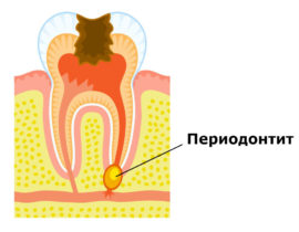 Signs of periodontitis