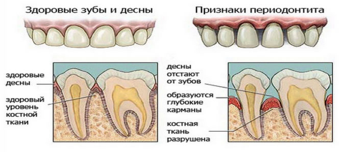 Mga palatandaan ng periodontitis