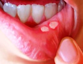 Signs of stomatitis
