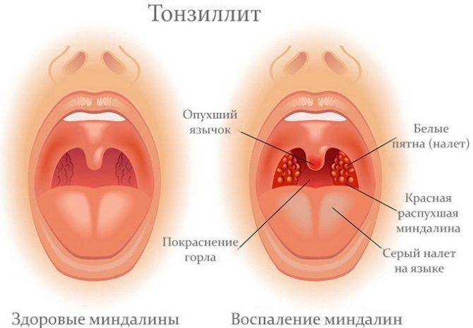Mga palatandaan ng tonsilitis