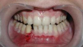 Khoảng cách trong răng với một vết nứt của hàm