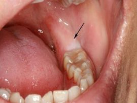 Tandande tredje molar