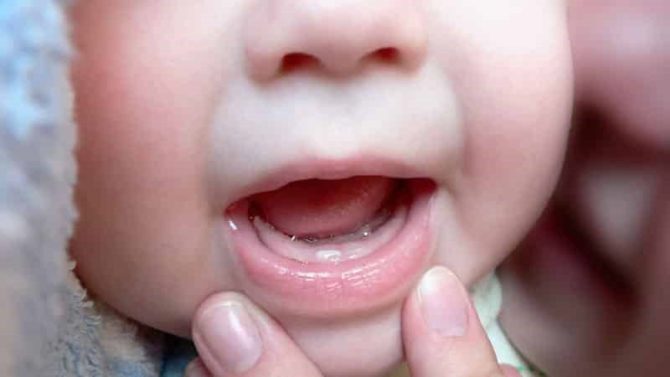 Zahnen zentraler Schneidezähne bei einem Säugling