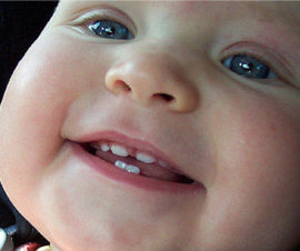 Teething upper fangs in a child