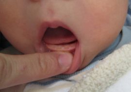 La dentition chez un bébé