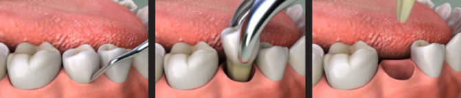 Snadná extrakce zubu