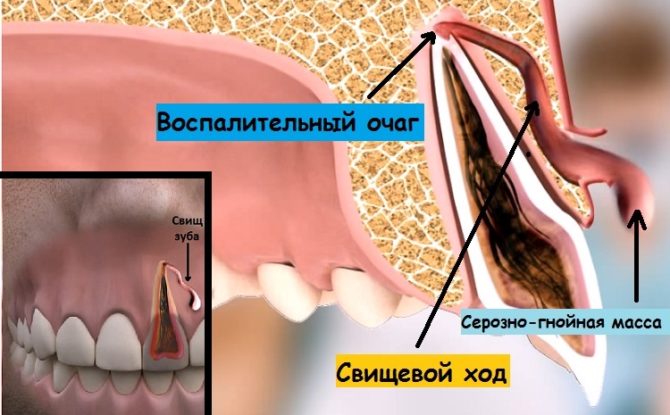 Der Prozess der Bildung einer Fistel auf dem Zahnfleisch