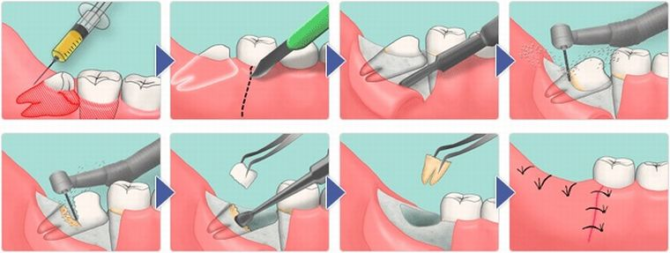 Išminties danties ištraukimo procesas