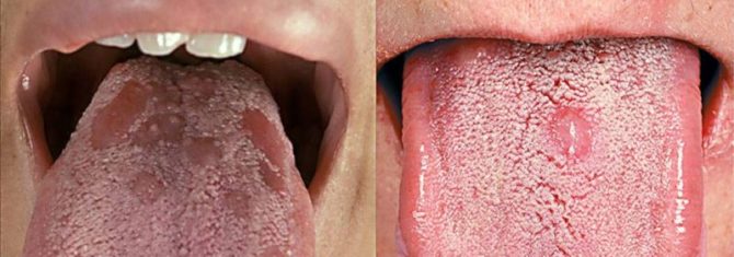 The manifestation of syphilis in the tongue