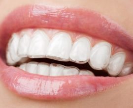 Transparent orthodontic tray
