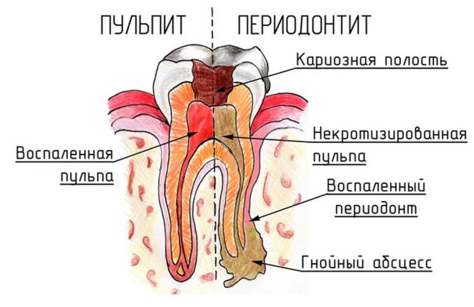 Pulpitis y periodontitis.