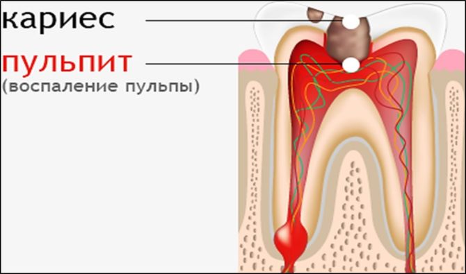 Zubní pulpitida