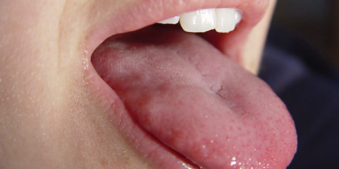 Flecken auf der Zunge