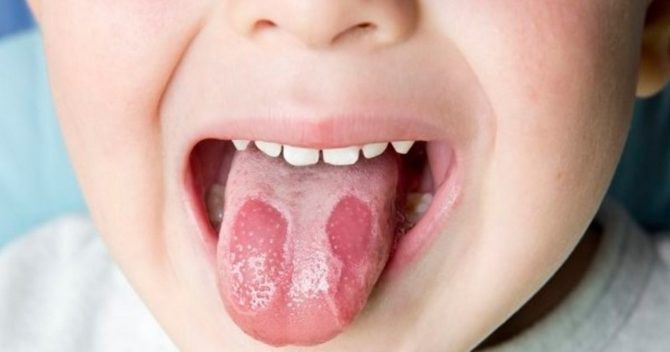 Spots on the tongue of the child