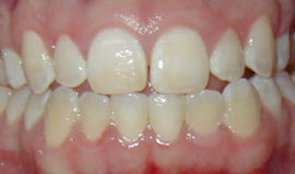 Skvrny na zubech v důsledku nerovnoměrné aplikaci bělícího gelu