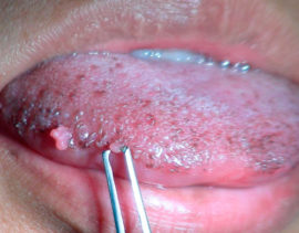 Cáncer de lengua